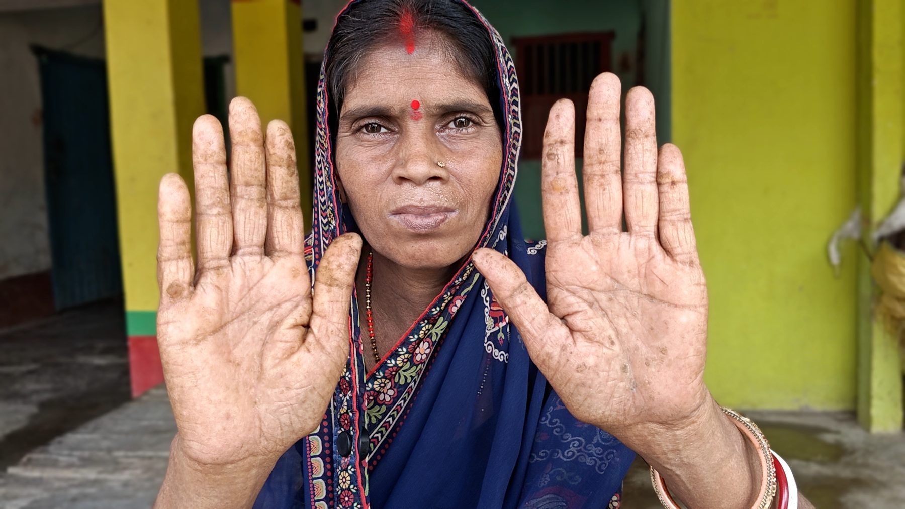 Pinki Devi's Keratosis 2