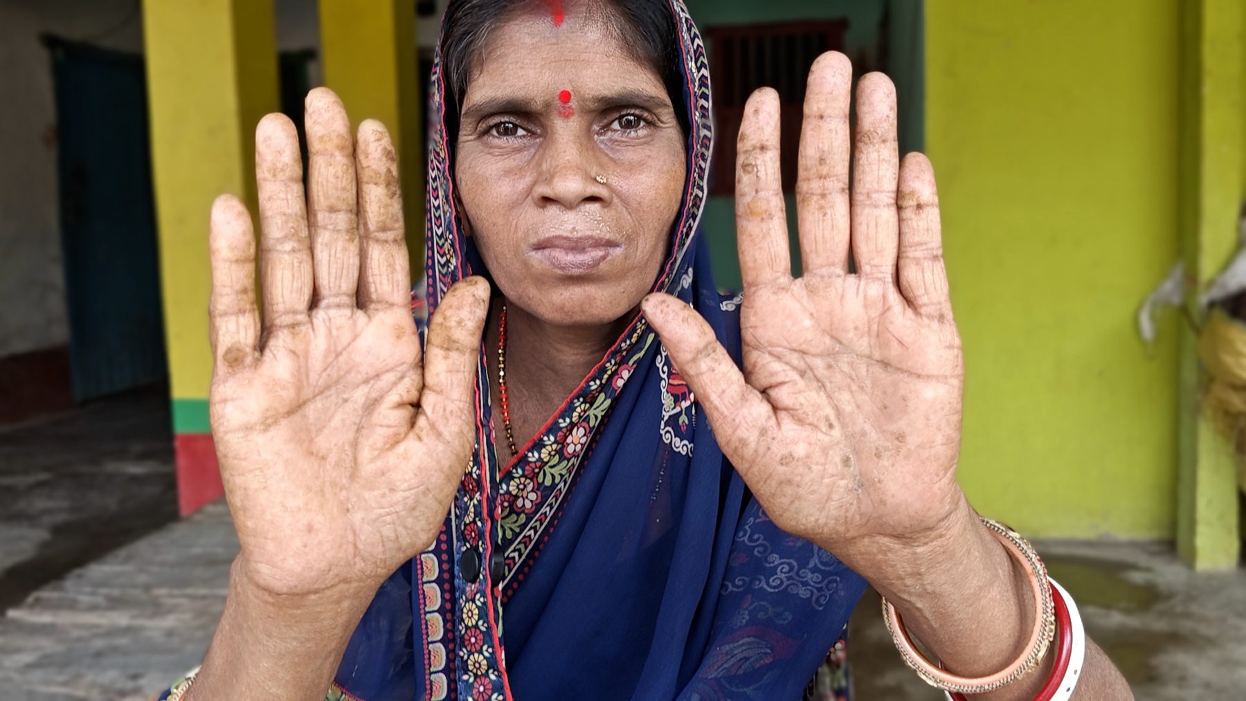 Pinki Devi's Keratosis1