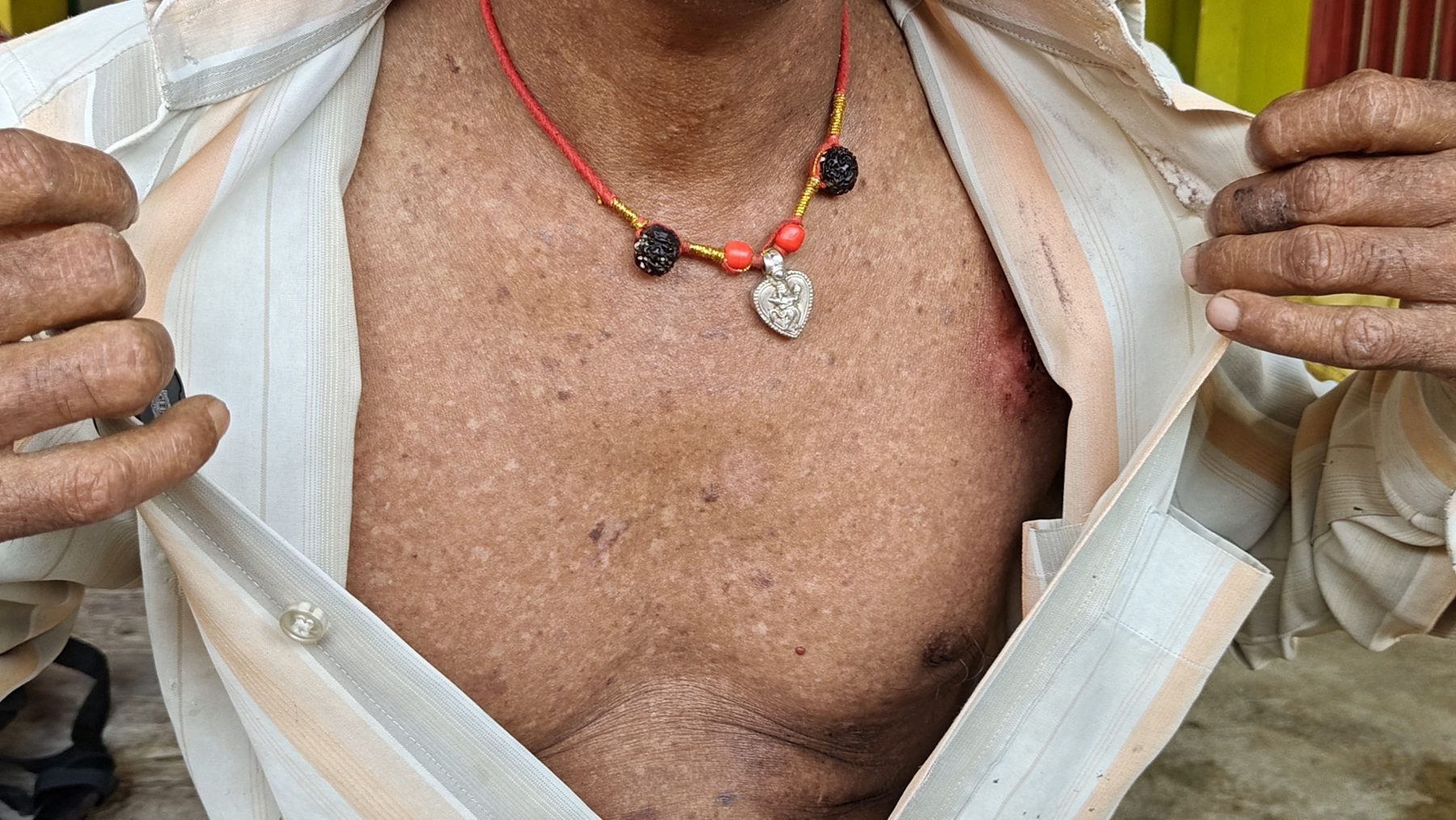 Udesh Mandal's body melanosis